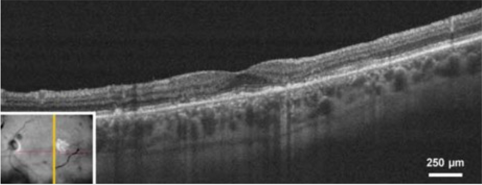 dryAMD.eu Imagen de tomografía de coherencia óptica (TCO) de un ojo en un paciente con atrofia geográfica.10