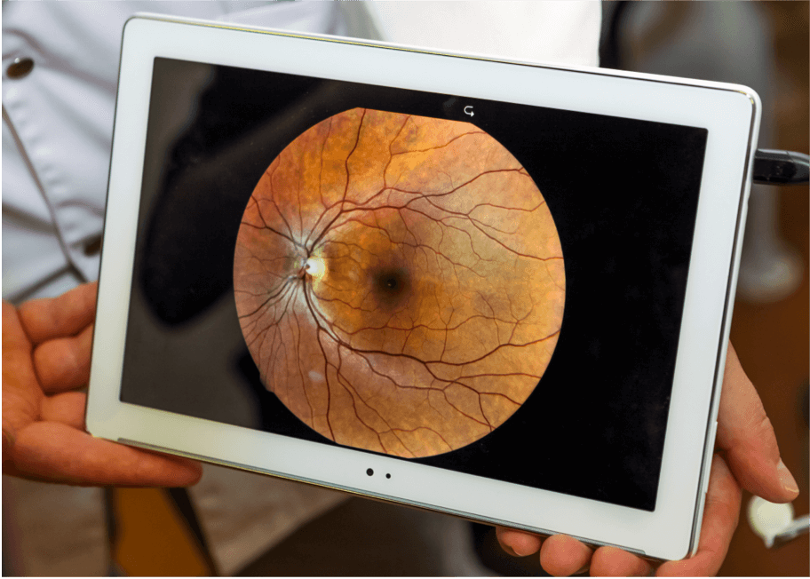 dryAMD.eu Imagen que muestra la parte de la retina afectada por la DMAE, tomada mediante fotografía de fondo de ojo.
