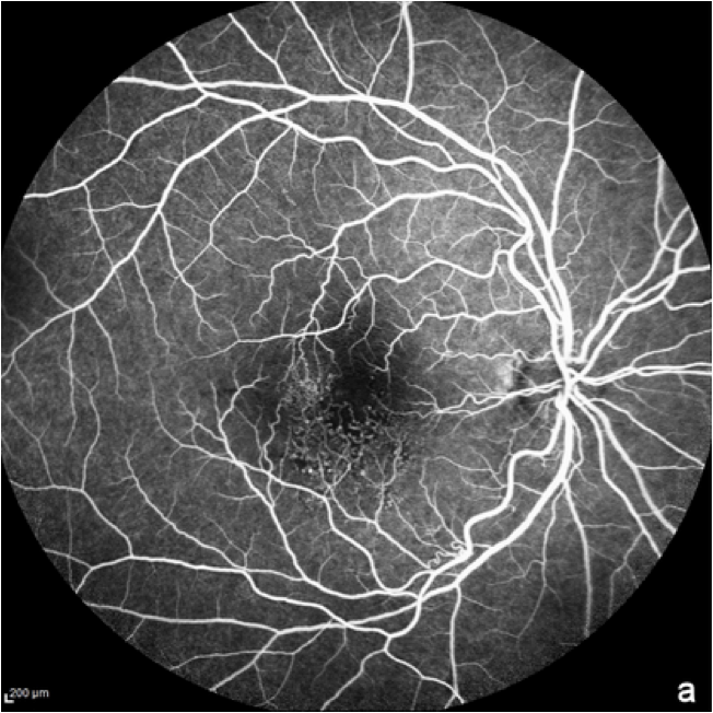 dryAMD.eu Image de l'angiographie à la fluorescéine du fond de l'œil aux premiers stades de la DMLA.