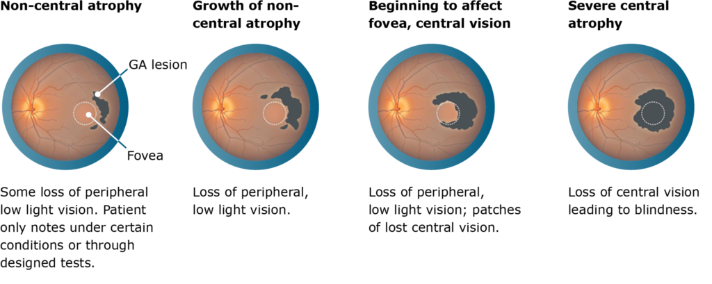 DryAMD The stages of advanced dry AMD or Geographic Atrophy.