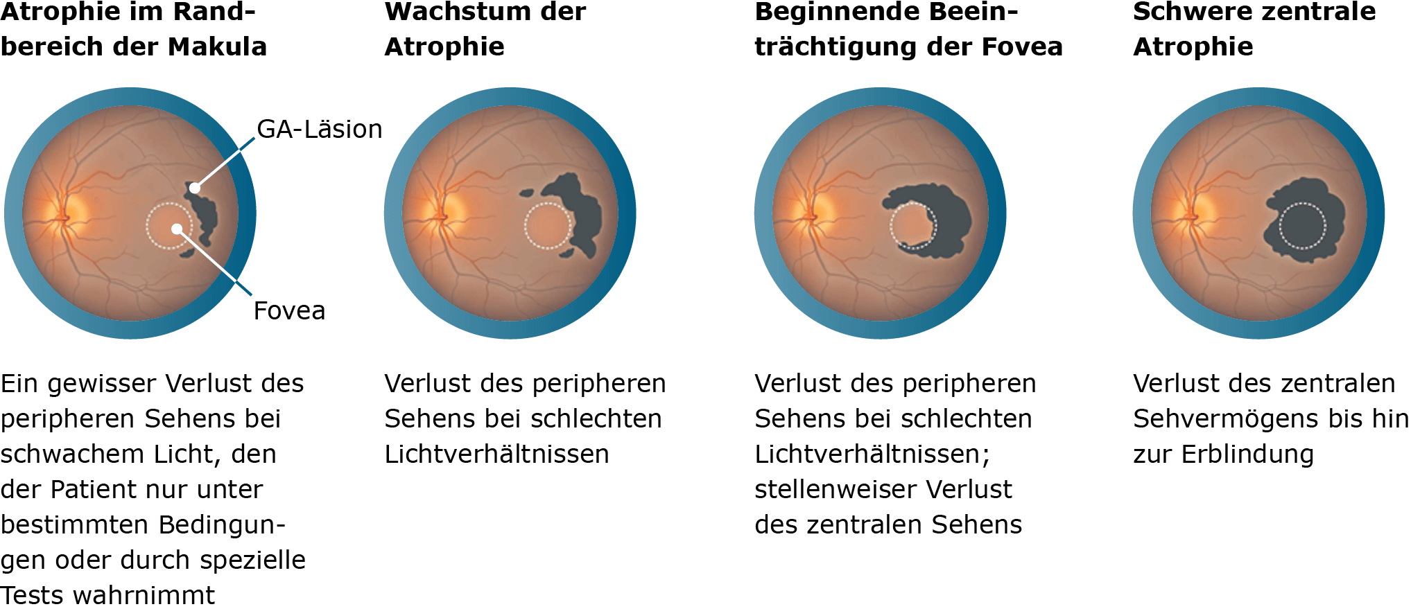 dryAMD.eu Grafik der Stadien der fortgeschrittenen trockenen AMD
oder geographischen Atrophie.