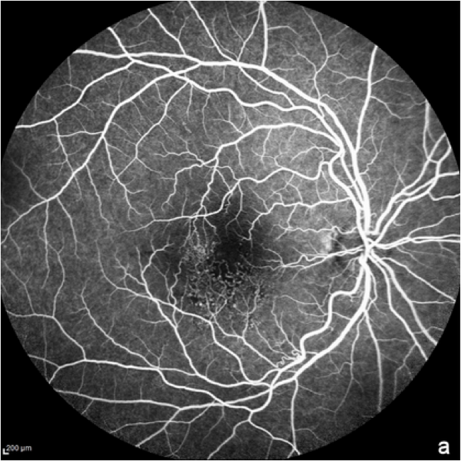 dryAMD.eu Eine Fluoreszenzangiographie des Auges.