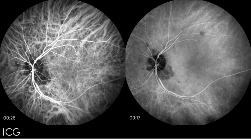 dryAMD.eu Indocyaningrün-Angiographiebilder des Auges.