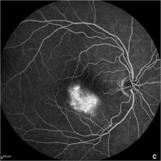 dryAMD.eu Imagen de la angiografía de fondo de ojo con fluoresceína en las primeras fases de la DMAE.