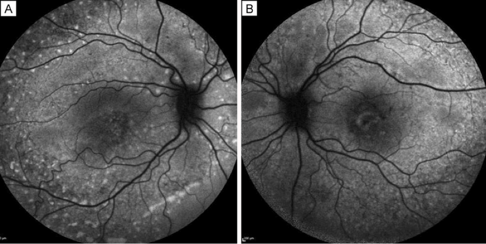 dryAMD.eu Imágenes de autofluorescencia del fondo de ojo con áreas oscuras que indican regiones atróficas.