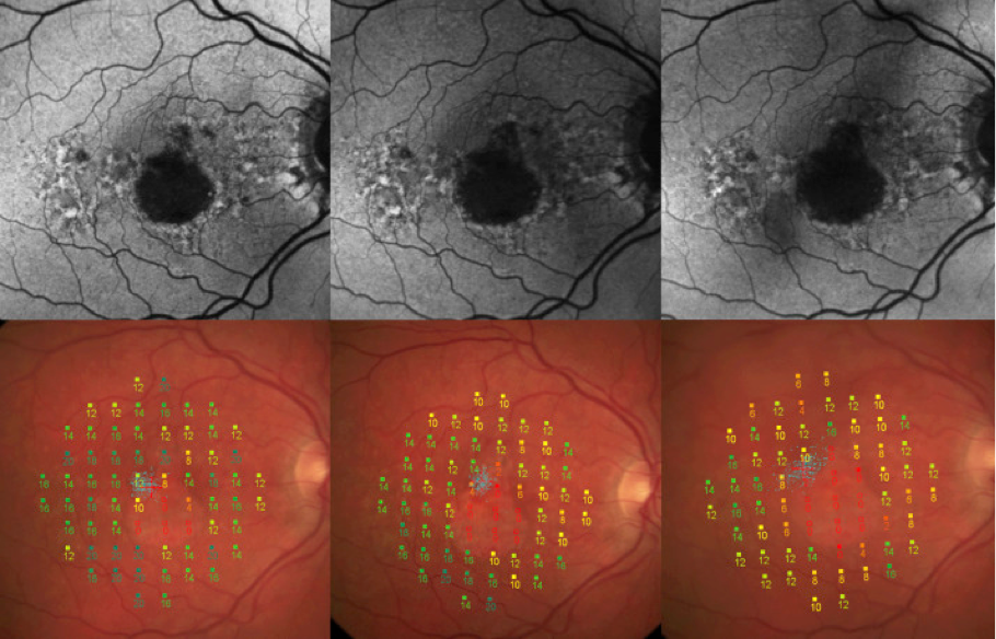 dryAMD.eu Imágenes de microperimetría de la retina.