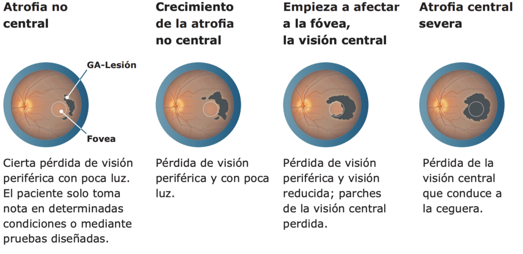 dryAMD Las etapas de la DMAE avanzada seca o atrofia geográfica.