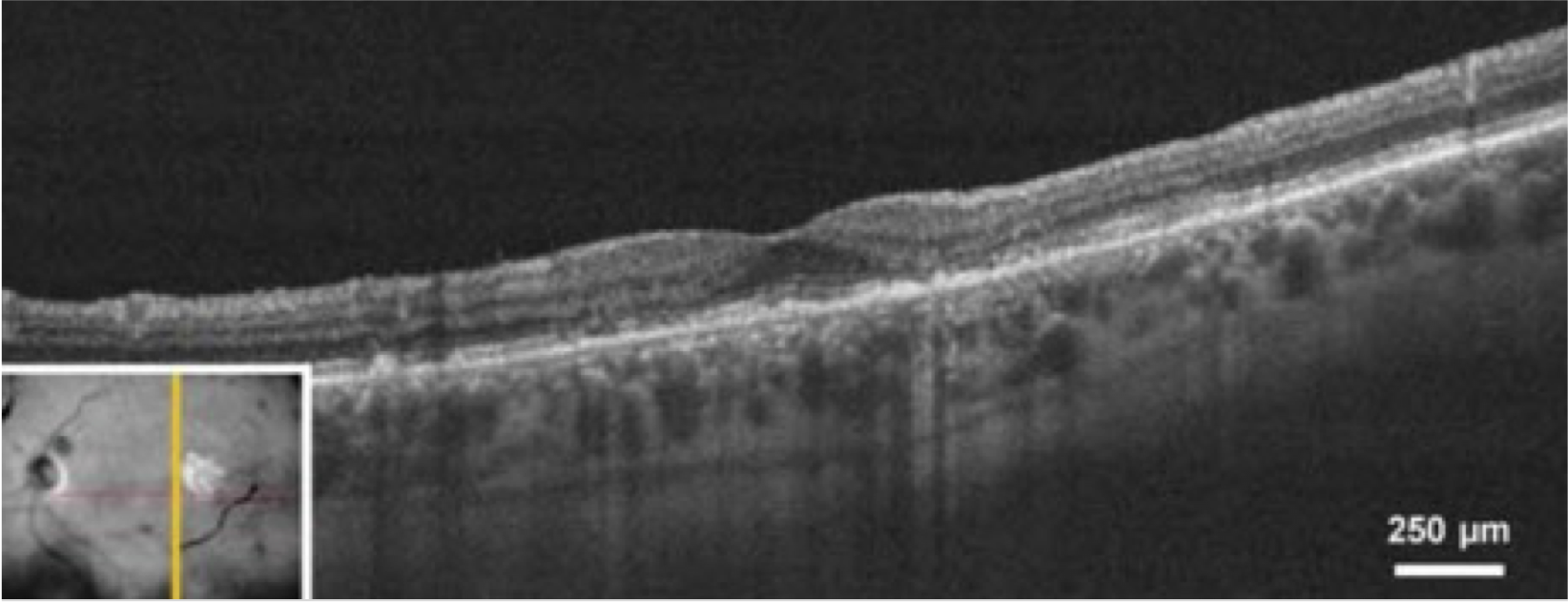 dryAMD.eu Image de tomographie par cohérence optique (OCT) d'un œil chez un patient atteint d'atrophie géographique.