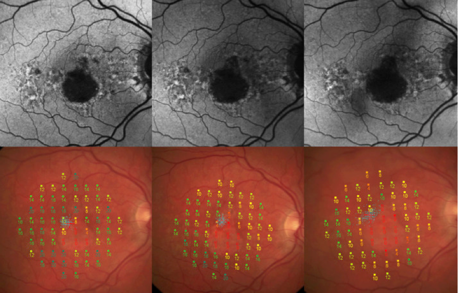 dryAMD.eu Images de microperimétrie de la rétine.