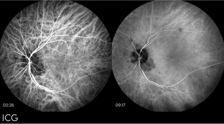 dryAMD.eu Images d'angiographie au vert d'indocyanine (ICG) montrant des parties fluorescentes dans la rétine.