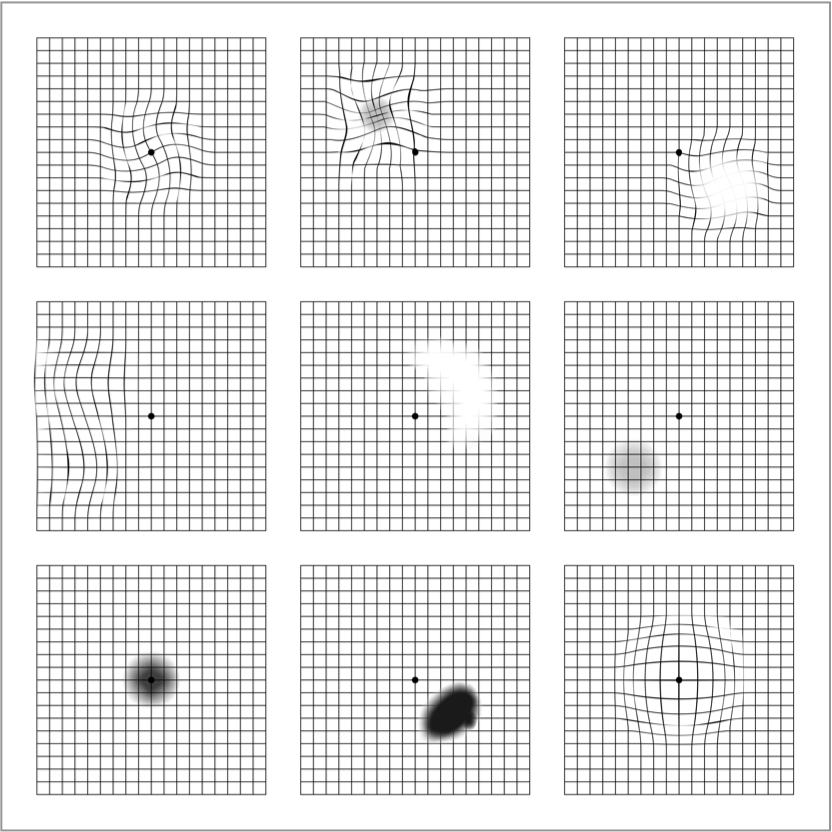 dryAMD.eu La griglia di Amsler come potrebbe essere percepita dai pazienti con AMD: con linee sfocate e/o un punto cieco vicino al centro.