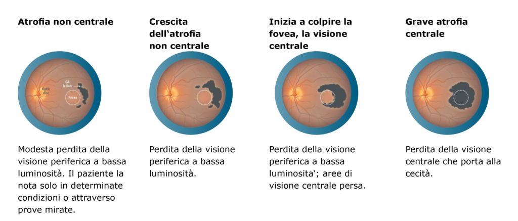dryAMD.eu Grafico delle fasi della AMD secca avanzata o atrofia geografica.