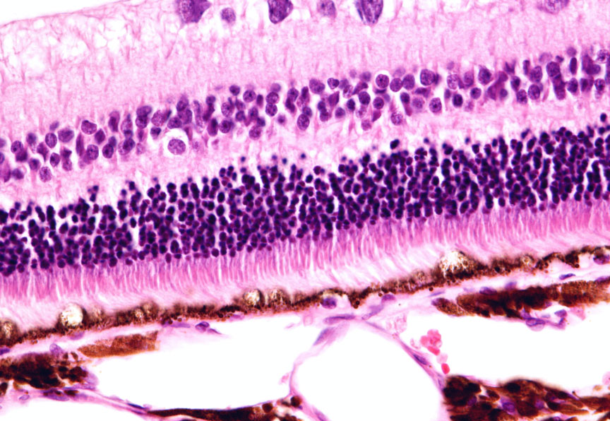 dryAMD.eu retinal disease detail view.