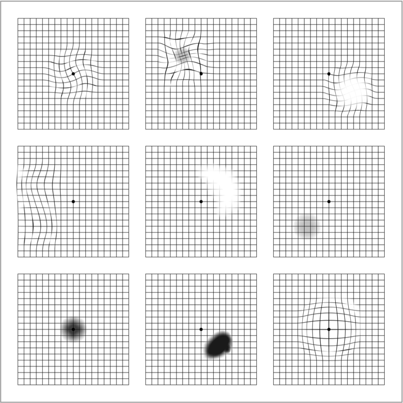 dryAMD.eu The Amsler grid as it might be perceived by patients with AMD with blurred lines and / or a blind spot near the centre.